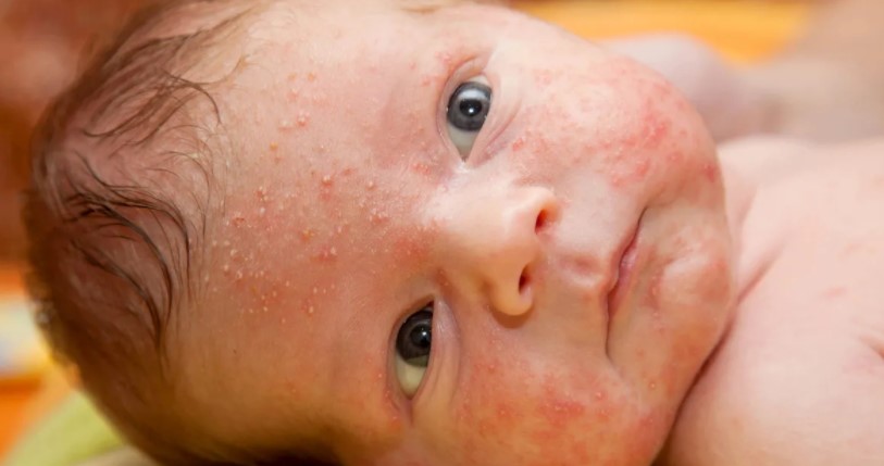 Baby Acne - Common Causes and Treatment of Neonatal Acne