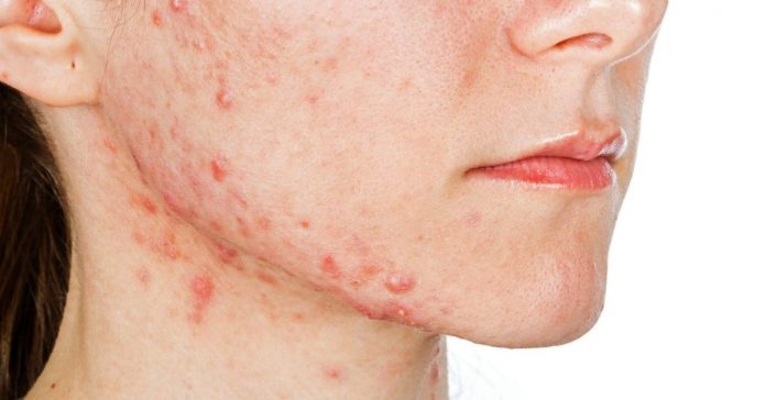 How to Heal Big Acne From Face Everyone Must Know