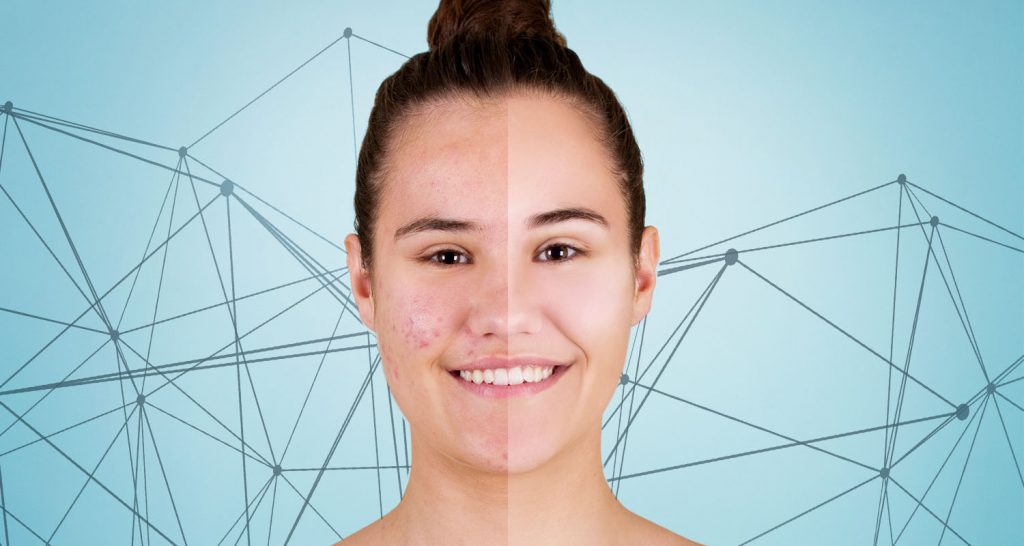 Know More About Acne And Its Treatment At A Glance