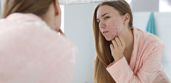 Occupational Acne Causes and Treatment You Should Know
