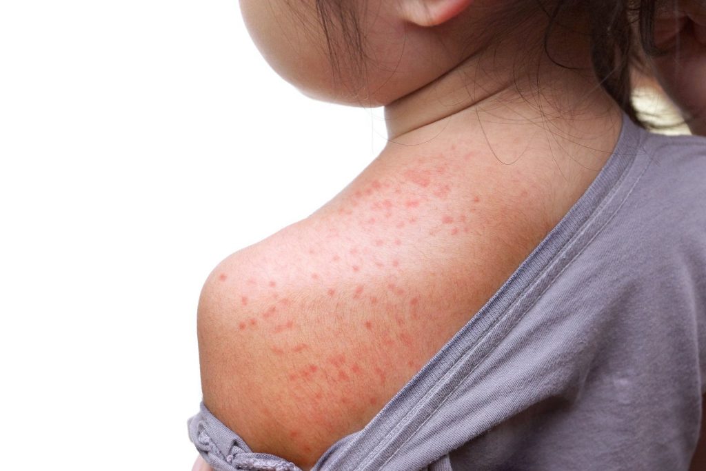 Skin Rash And It's Treatment - Everything You Should Know