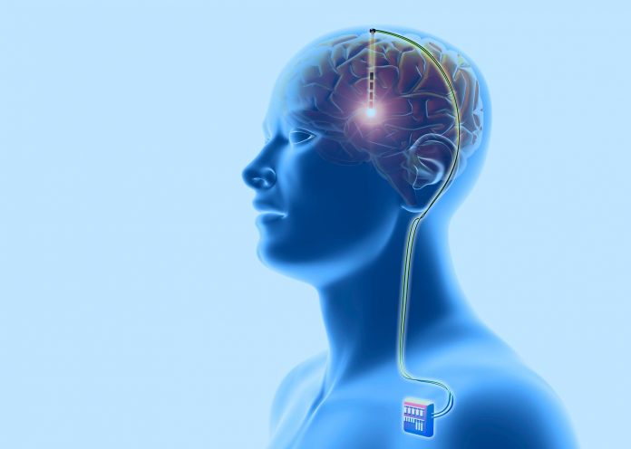 Study revealed, Deep Brain Stimulation best For Mental illness