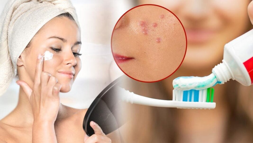 Can Toothpaste Help with Acne?