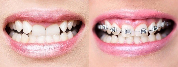 How Braces Align Your Teeth