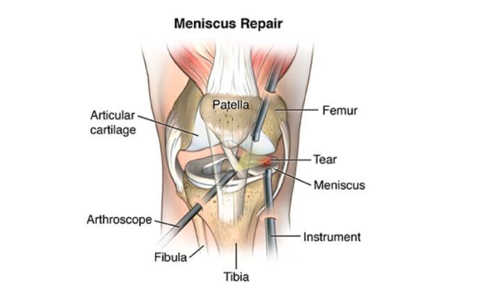 What is the Best Treatment For a Meniscus Tear?