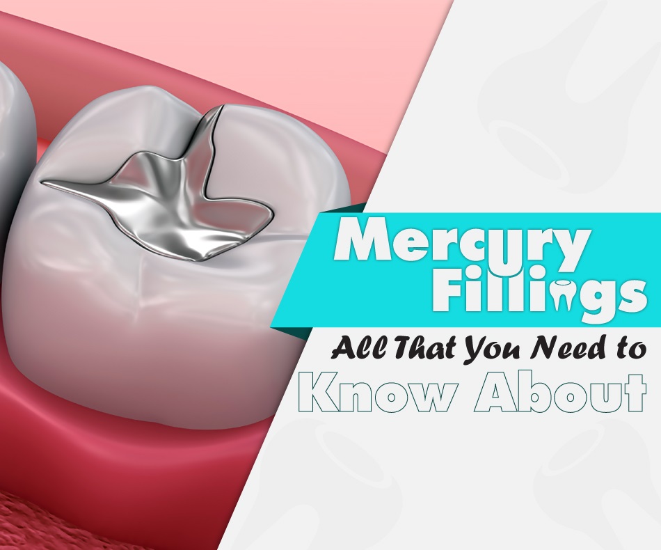 Mercury Fillings: All That You Need to Know About