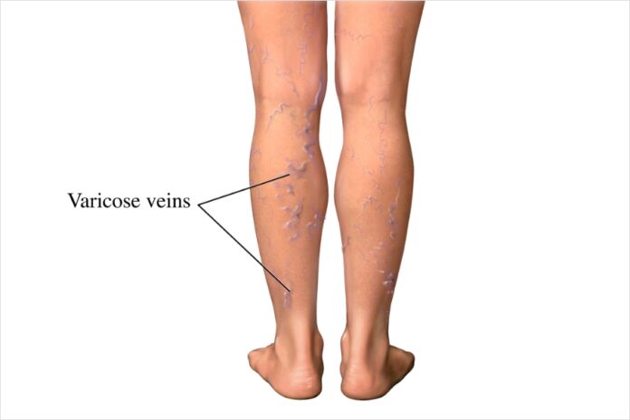 Varicose Veins: Causes and Symptoms