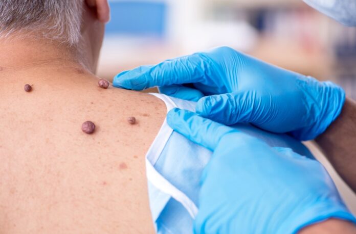 How dermatologists remove skin tags?