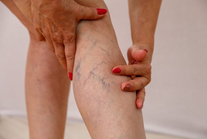 What You Might Not Know About Spider Veins