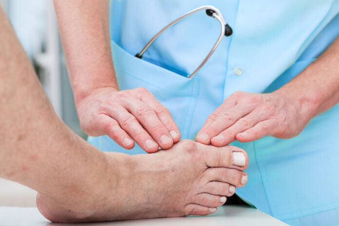 5 Tips to Prevent Bunions