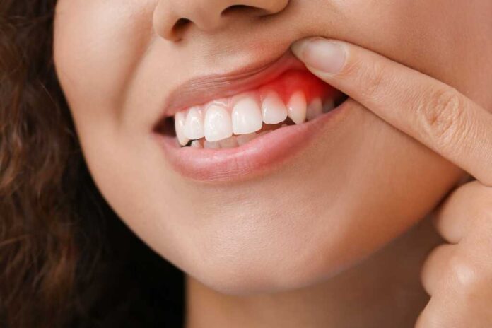 Gum Inflammation, Gingivitis, and Periodontal Disease
