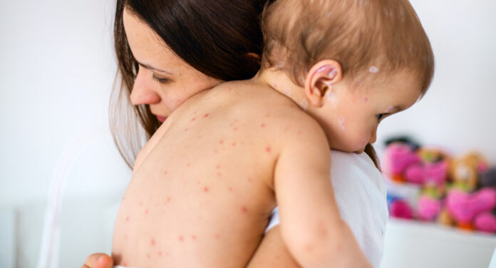 6 Best Home Remedies for Chickenpox: A Beginner's Guide